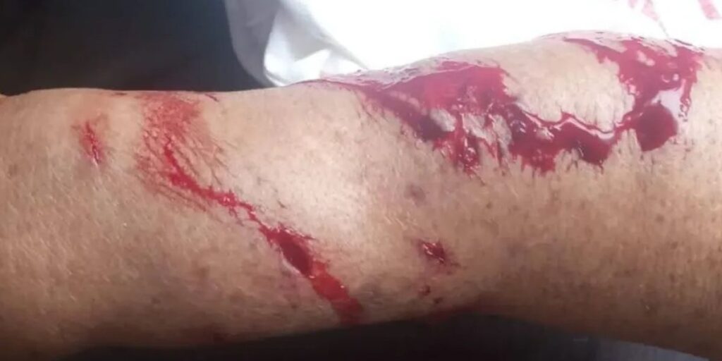 Dois Pitbulls 4tacam senhora em Pirenópolis - IMAGEM SENSIVEL 6